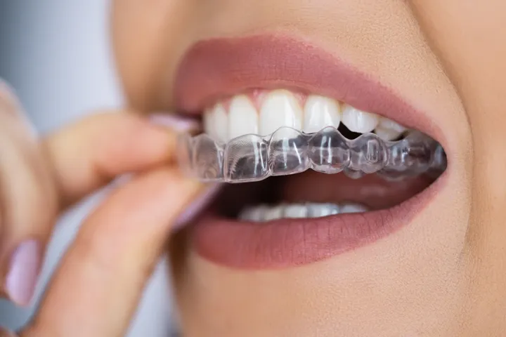 Clear aligner trays shown on a neutral surface, illustrating the removable tray system