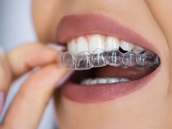 Clear aligner trays on a clean surface