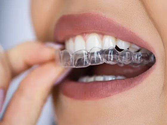 Clear aligner trays on a neutral surface