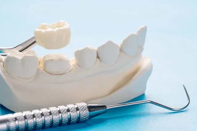 Natural-looking dental crown restoration showing the finished ceramic crown in place