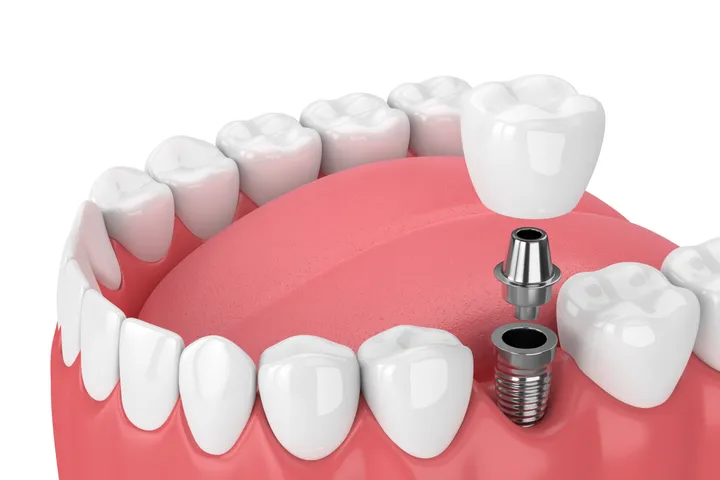 Titanium dental implant post shown in a model jaw, illustrating placement below the gumline