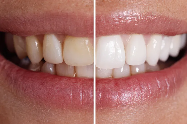 Dental hygienist performing a professional cleaning, working carefully with a patient