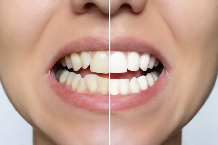 Close-up of porcelain veneers showing the natural look and finish of the ceramic shells