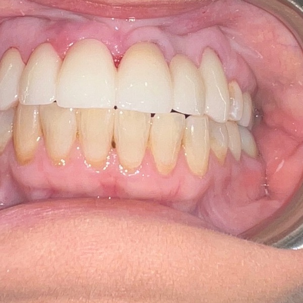 After: Smile alignment and restoration