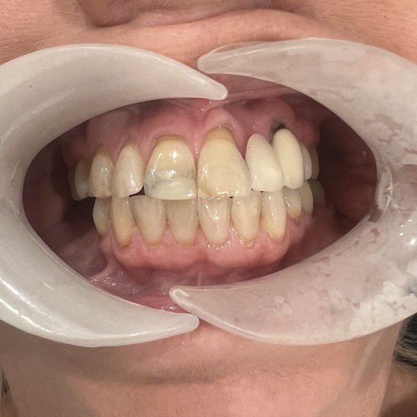Before: Smile alignment and restoration
