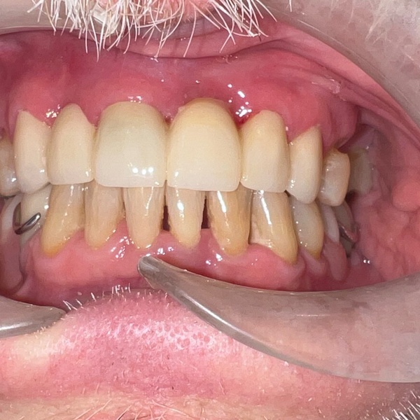 After: Full mouth reconstruction