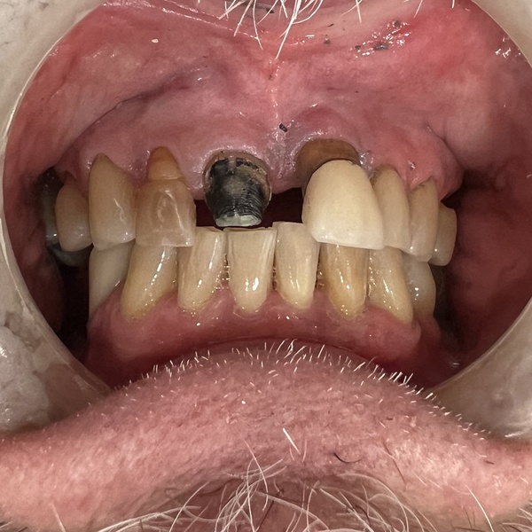 Before: Full mouth reconstruction