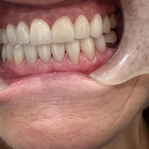 After: Cosmetic smile makeover
