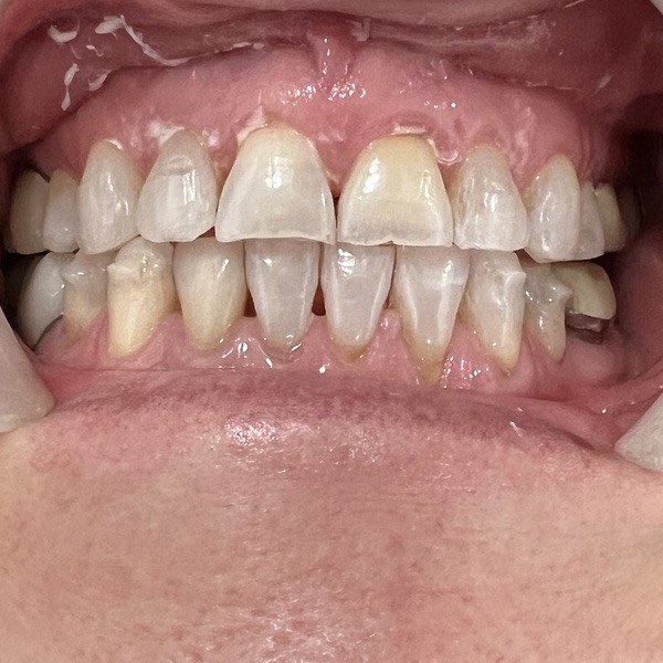 Before: Cosmetic smile makeover