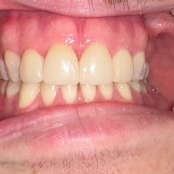 After: Bite alignment correction
