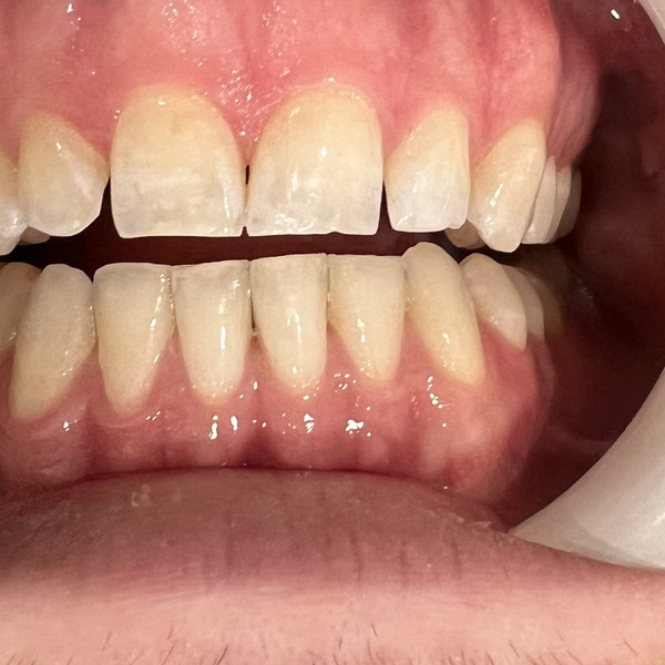 Before: Bite alignment correction