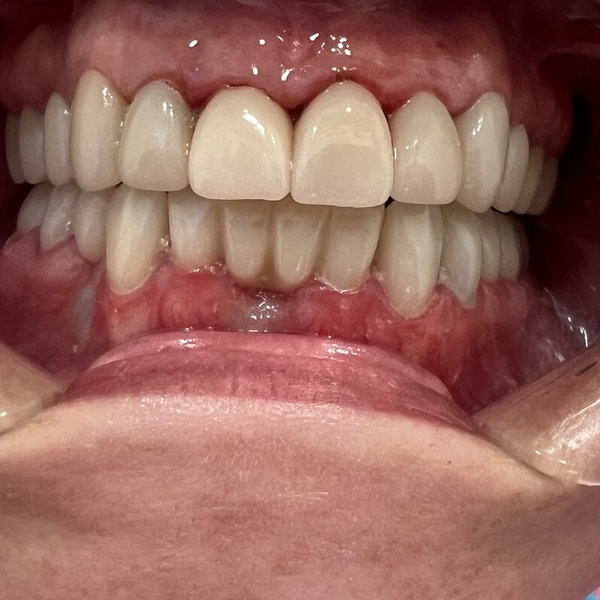 After: Full mouth rehabilitation