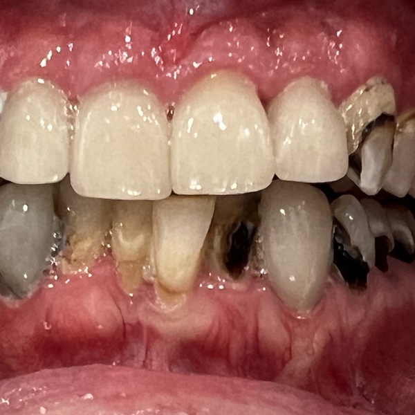 Before: Full mouth rehabilitation