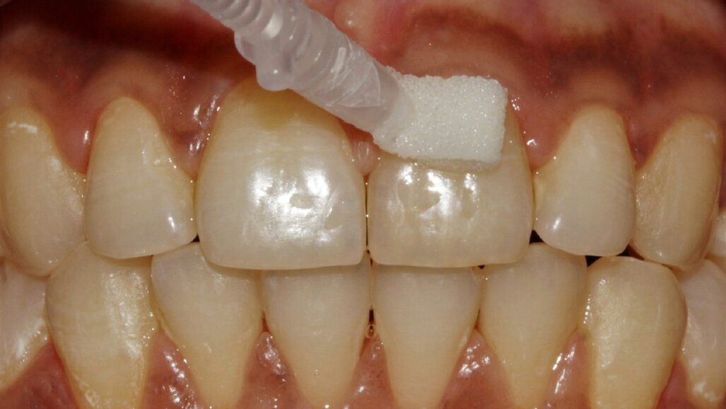 Curodont being applied to the surface of a front tooth with a small sponge applicator