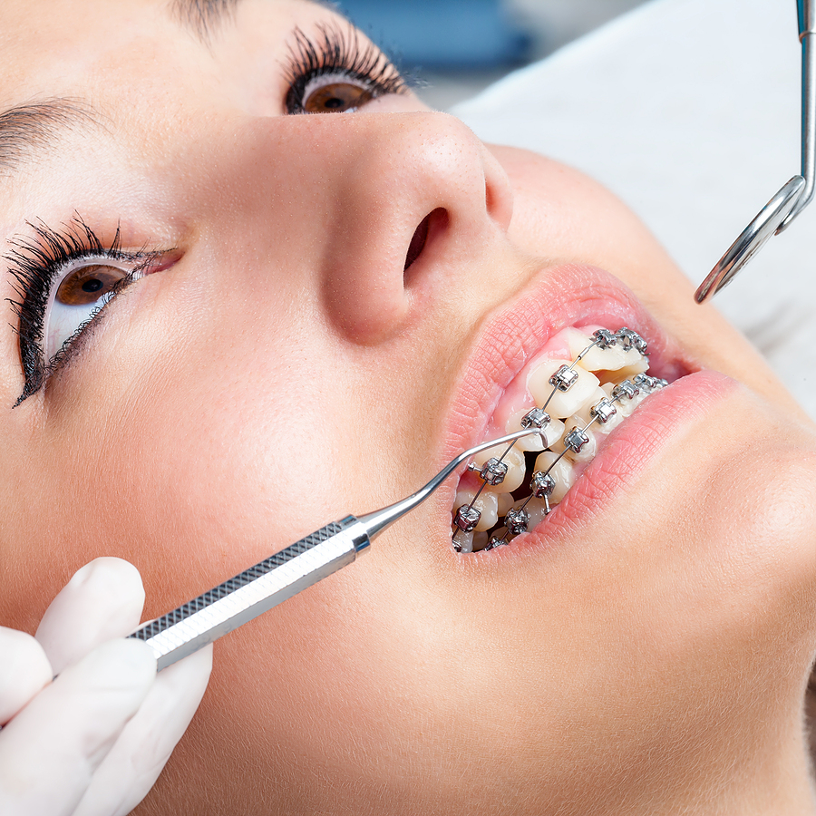 Achieve a Straighter Smile with Braces in Garland, TX