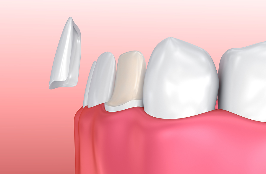 Transform Your Smile with Dental Veneers in Garland, TX