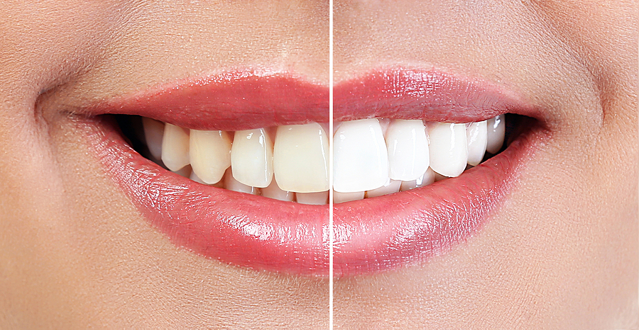 Brighten Your Smile with Teeth Whitening in Garland, TX