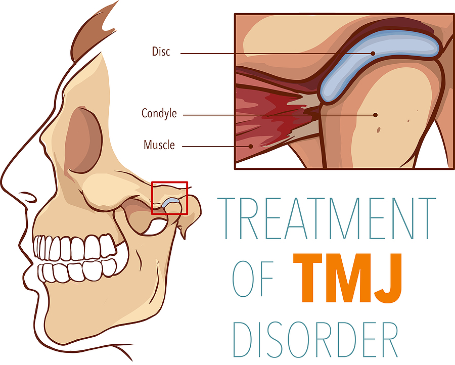 Effective TMJ Therapy in Garland, TX: Relieving Jaw Pain and Discomfort